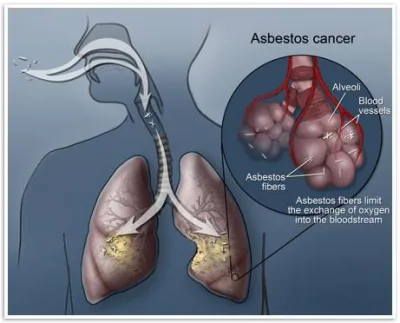 Factors Affecting The Risk of Developing Diseases Related to Asbestos