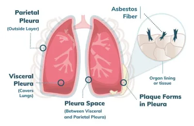 Pleural Mesothelioma and it’s Causative Agents